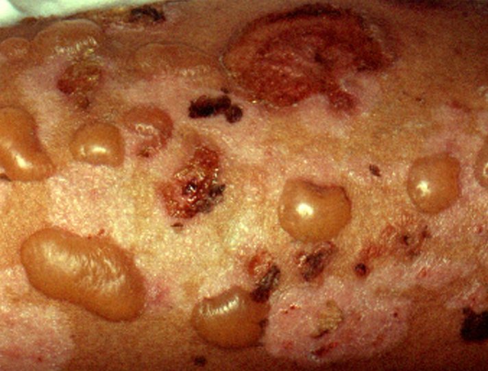 What is the treatment for bullous pemphigoid?