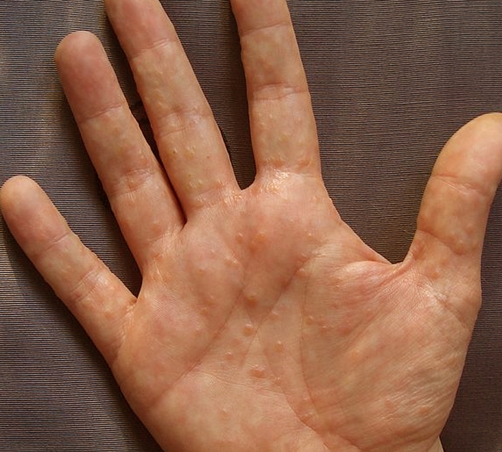 Dyshidrosis Overview - Mayo Clinic
