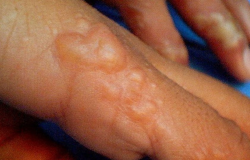 Blisters on hands and feet - Small itchy water blisters ...