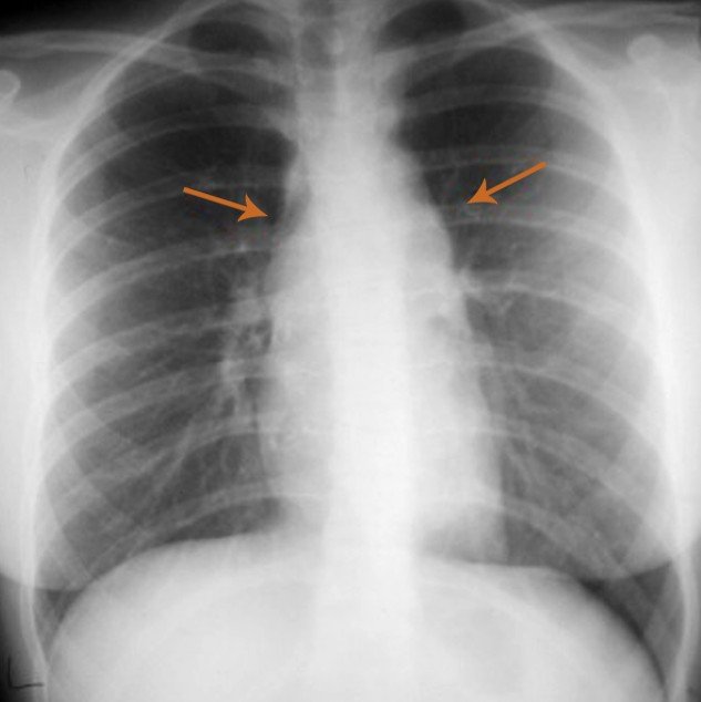 cxrs-hilar-lymphadenopathy-and-high-yield-associations-for-the-usmle