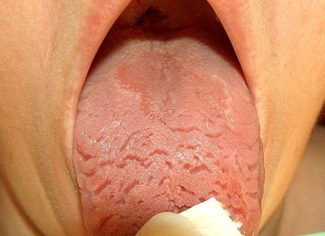 Vitamin B Deficiency Cracked Tongue Due