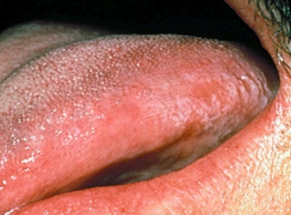 Hairy Tongue Leukoplakia 2