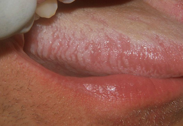 Hairy Tongue Leukoplakia 35