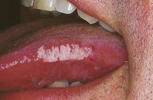 Oral Hairy Leukoplakia Pictures 52