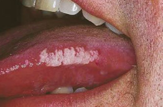 Hairy Leukoplakia 80