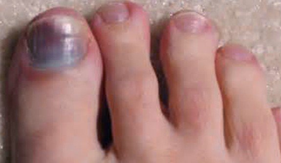 why-has-my-toenail-turned-black-the-chiropody-clinic-enfield