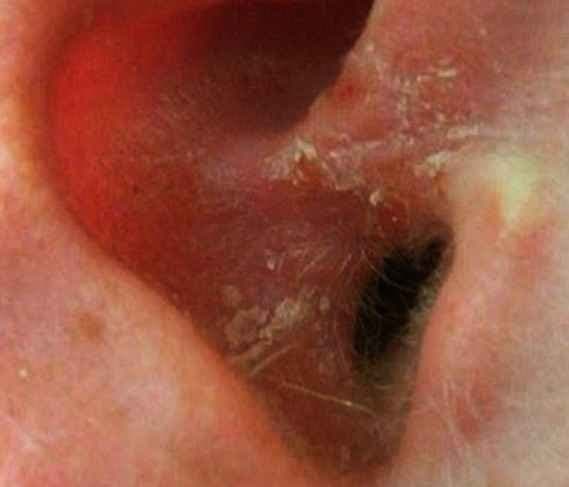 Dry Skin in Ears