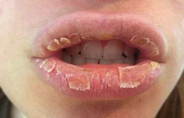 Exfoliative Cheilitis