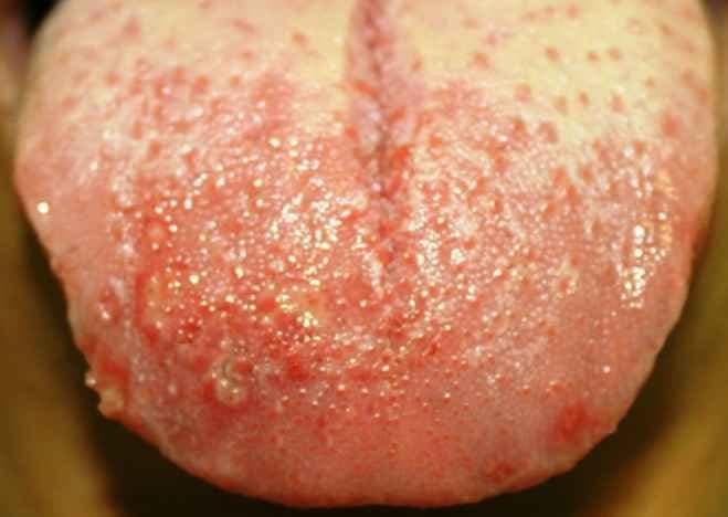Herpes on Tongue