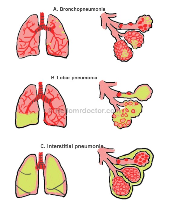 bronchitis vs pneumonia lung sounds