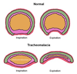 tracheomalacia nocturnal cough