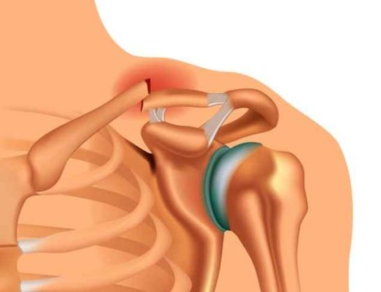 14-common-causes-of-collarbone-pain-and-how-to-treat-them