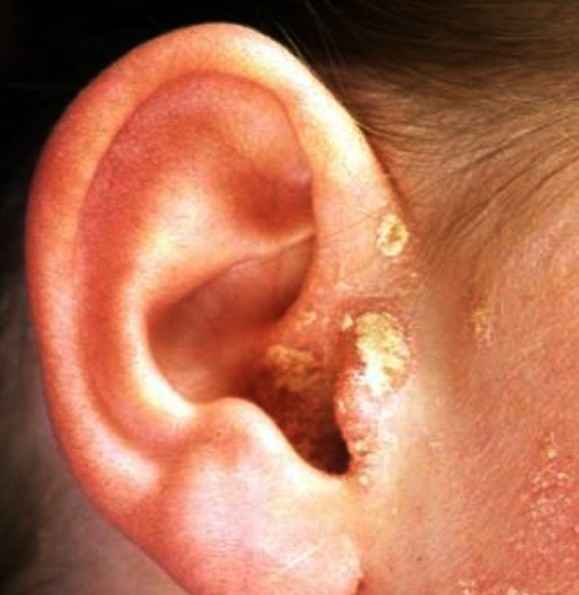Dry Skin In Ears Pictures What Causes It And How To Treat