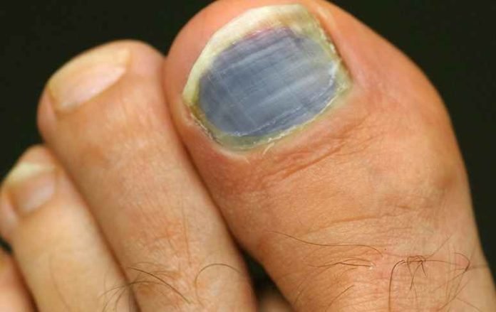 Toenails Turning Blue Symptoms Causes Treatment 