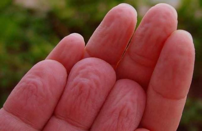 wrinkled-fingertips-causes-treatment-pain-redness-lupus-thyroid