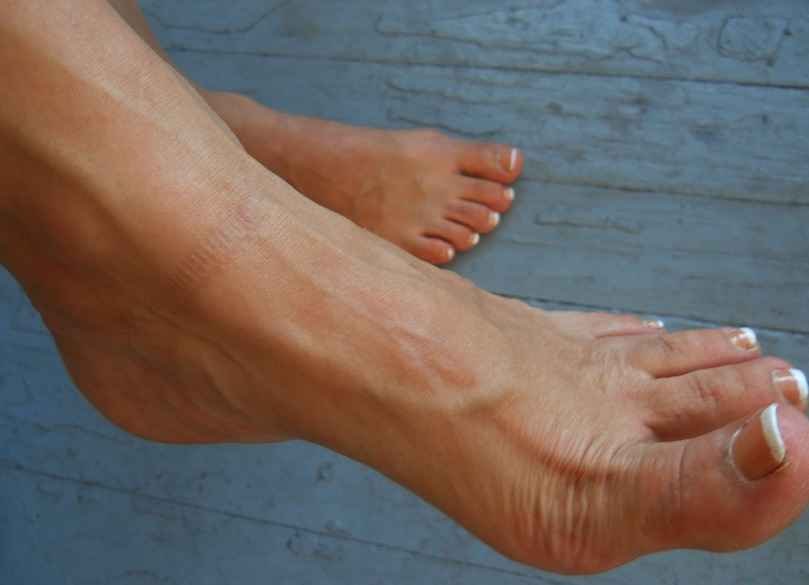 Bulging Veins Pictures Causes Prevention And Treatment