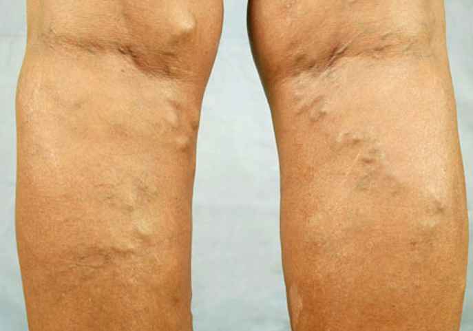 Bulging Veins - Pictures, Causes, Prevention and Treatment,