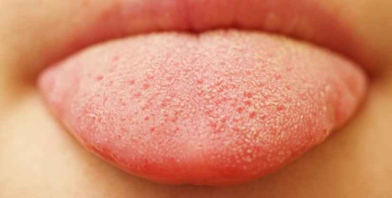 Bumps On The Tongue 9 Common Causes Pictures Treatment 8696