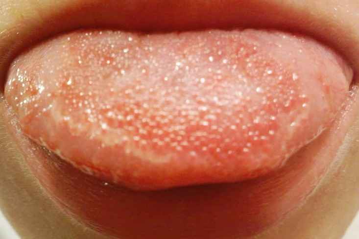 Bumps on the Tongue - 9 Common Causes, Pictures, Treatment
