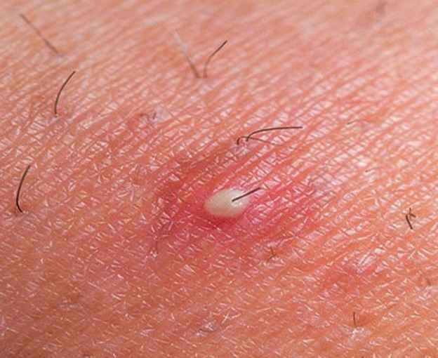 Ingrown Hair On Thigh Pictures Causes And Treatment