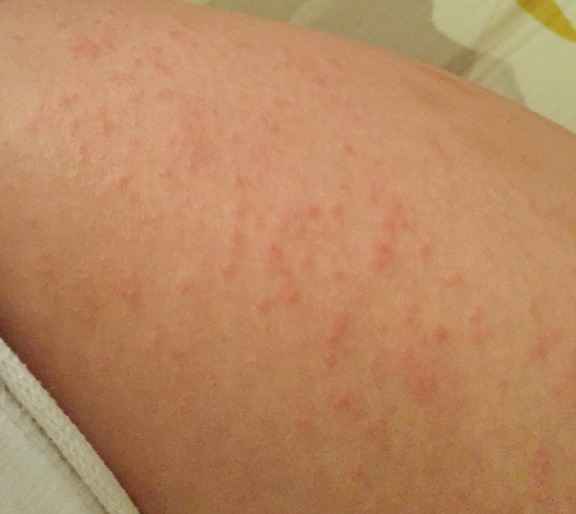 Itchy Bumps On Arms Pictures 2 