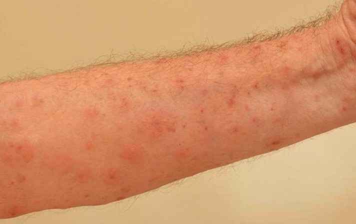 Itchy Bumps On Arms Pictures Symptoms Causes Treatment