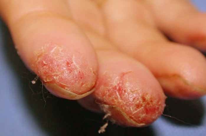 peeling-fingertips-pictures-causes-and-treatment