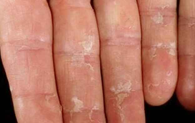 Peeling Fingertips Pictures Causes And Treatment