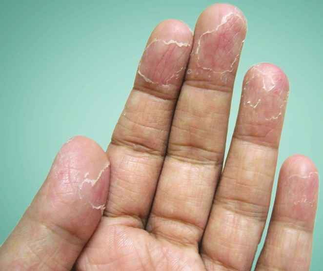 finger skin peeling