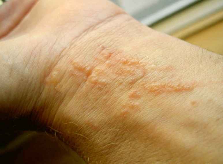 Types Of Poison Ivy Rash 