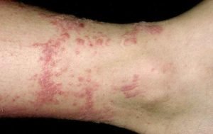 Health and Medical ArticlesPoison Ivy Rash - Health and Medical Articles