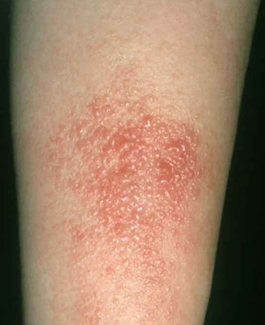 Poison Ivy Rash Pictures Causes Treatment Contagious