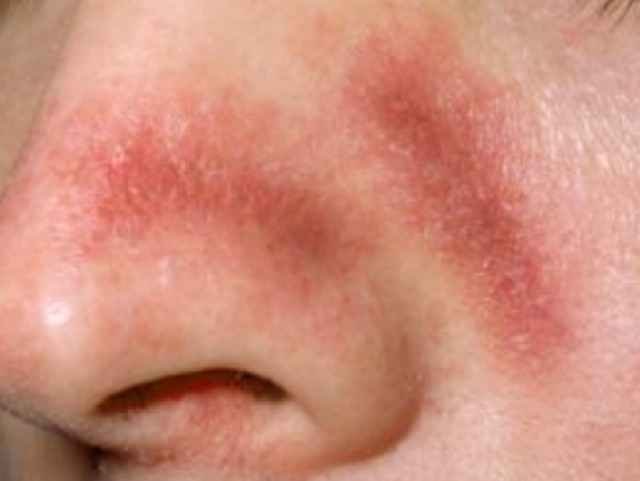 what-is-red-blotchy-skin-pictures-causes-and-how-to-treat