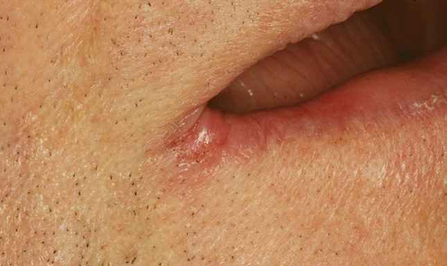 What Do Pimples On The Corner Of Your Mouth Mean