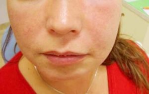 Swollen Cheek - Symptoms, Causes, Treatment, Pictures