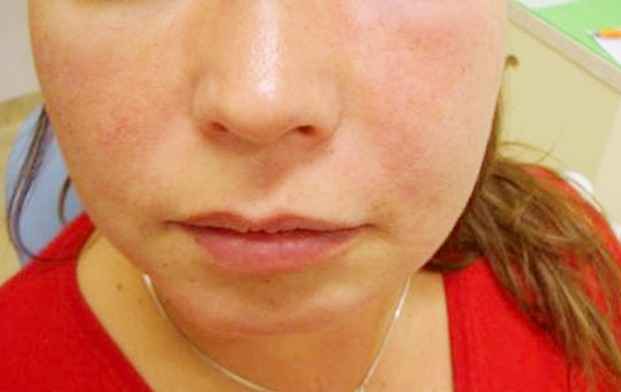 Swollen Cheek Symptoms Causes Treatment Pictures 2022