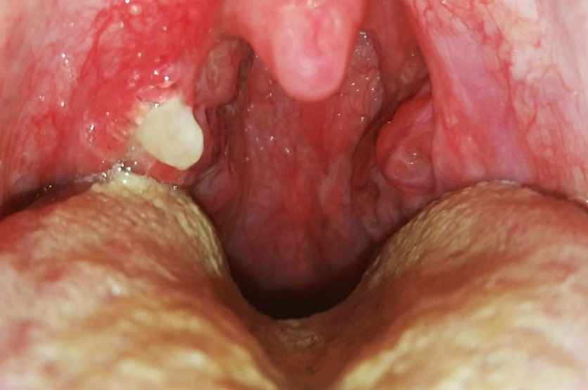 Can I Still Give Oral Sex To My Boyfriend With Bacterial Tonsilitis